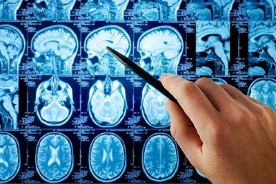 Brain damage shown in MRI