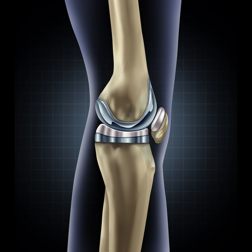 Zimmer Knee Replacement