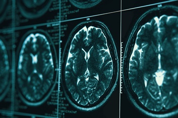 Brain Scans After a Slip and Fall