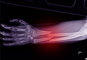 Broken Arm Bones After a Motorcycle Wreck