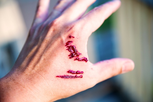 dog bite injury on hand